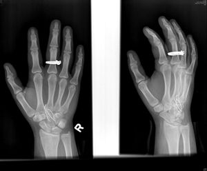 Radiologists identify new self-embedding disorder plaguing teens
