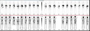 Emerging CAIX PET Agent Garners FDA Breakthrough Therapy and Fast Track Designations for ccRCC