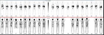 Emerging CAIX PET Agent Garners FDA Breakthrough Therapy and Fast Track Designations for ccRCC