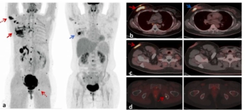 Researchers Show Higher Breast Cancer Upstaging Rate with 18F-FAPI PET/CT