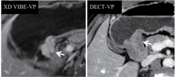 Study Shows Benefits of mpMRI over Dual-Energy CT for Gastric Cancer Staging