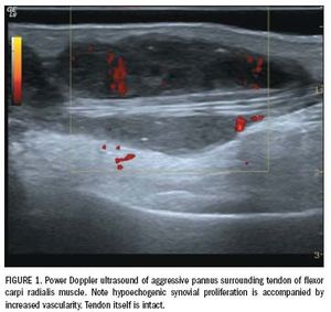 Modern sonographic methods improve arthritis work-up