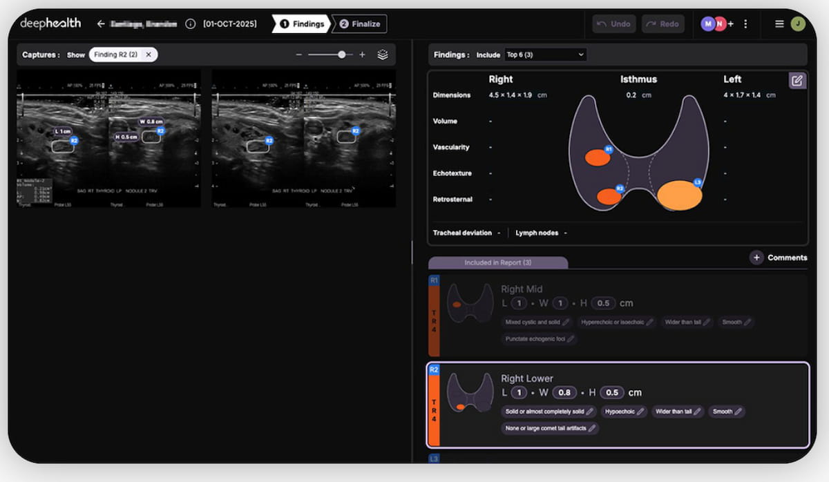 ECR Study: Adjunctive AI Facilitates 38 Percent Reduction in Ultrasound Assessment Time for Thyroid Nodules