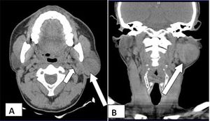 Unilateral Warthin Tumor Mimics Cystic Pleomorphic Adenoma 