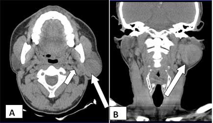 pleomorphic adenoma parotid ct