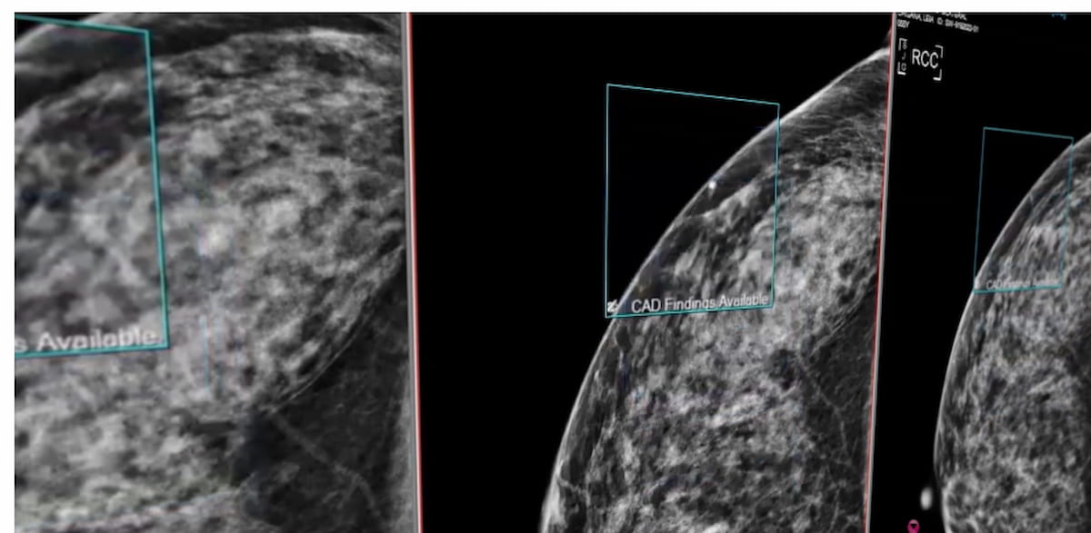 Novarad Launches Breast Imaging Platform MammoIQ | Diagnostic Imaging