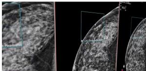 Novarad Launches Breast Imaging Platform MammoIQ