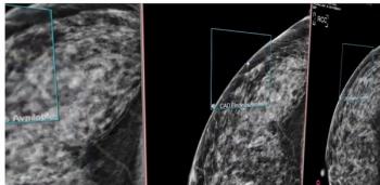 Novarad Launches Breast Imaging Platform MammoIQ