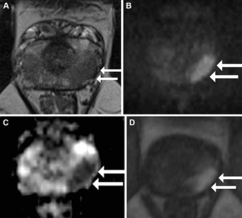 Study: mpMRI-Targeted Biopsies Offer Better Detection of Cribriform and Intraductal PCa than Systematic Biopsies