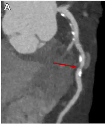 How to Successfully Launch a CCTA Program at Your Hospital or Practice