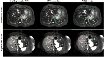 Emerging Research Shows Potential of Online Segmentation Model for MRI