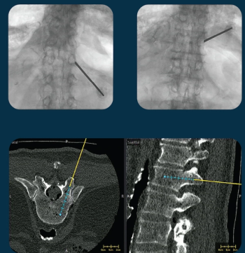 FDA Clears Updated 3D Imaging Guidance for Spine Surgery
