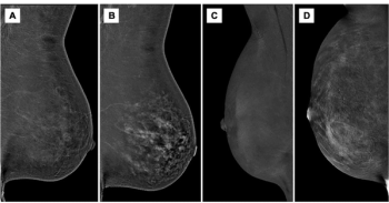 How Does Hormonal Regulation Impact Background Parenchymal Enhancement on Contrast-Enhanced Mammography?