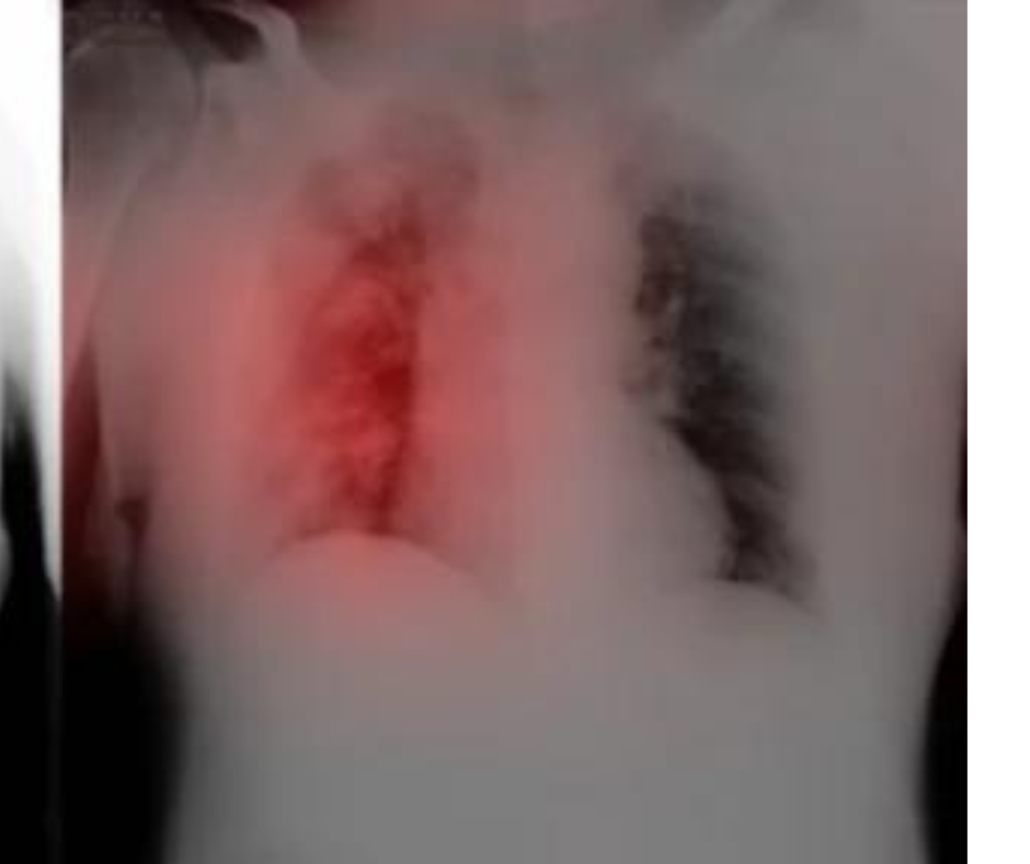 Could AI Enhance Early Detection of COVID-19 on Chest X-Rays?