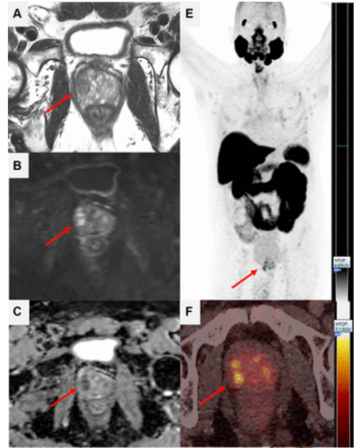 Study: PSMA PET/CT Agent May Rule Out csPCa in 93 Percent of PI-RADS 3 Lesions