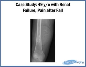 49 y/o with Renal Failure, Pain after Fall