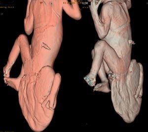 Ischiopagus Parasiticus Bipus