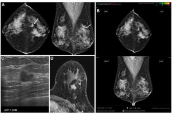 New Study Examines Key Factors with False Negatives on AI Mammography Analysis
