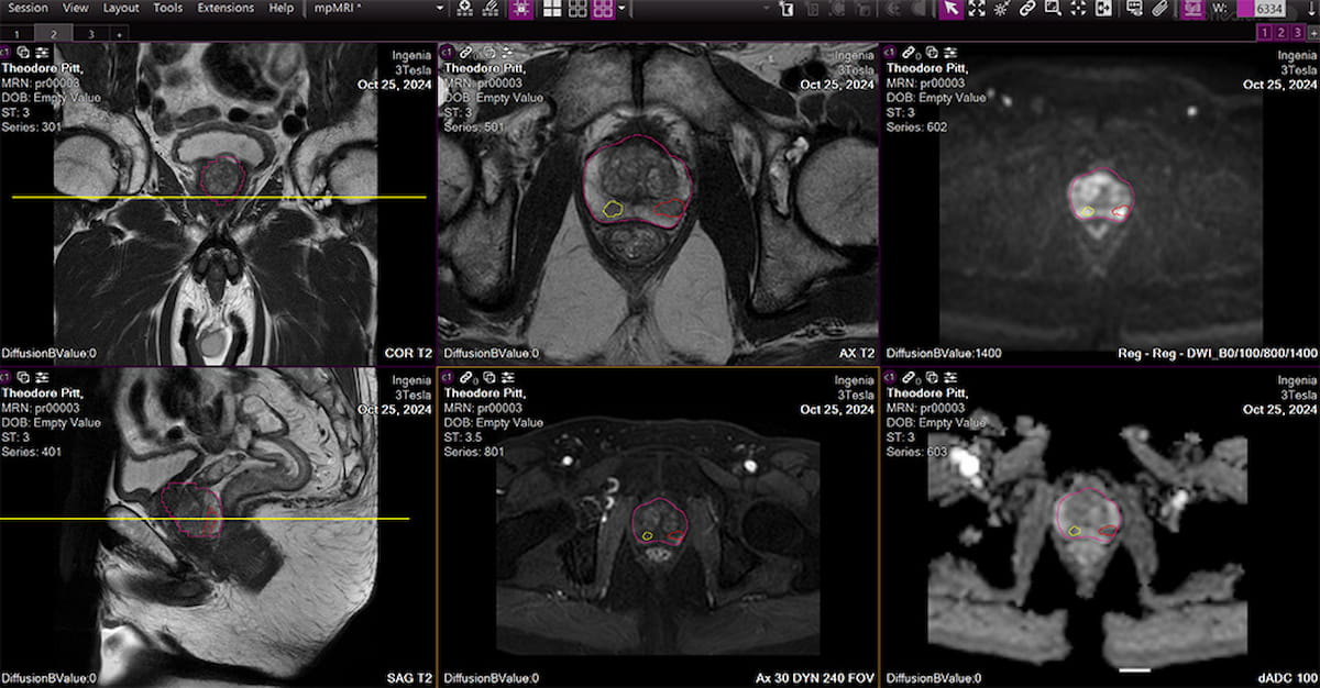 FDA Clears Emerging AI Software Application for Prostate MRI