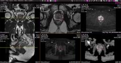 FDA Clears Emerging AI Software Application for Prostate MRI 