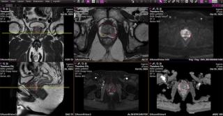 FDA Clears Emerging AI Software Application for Prostate MRI 