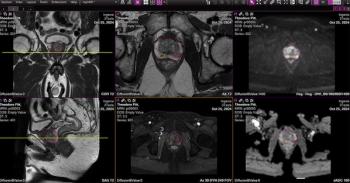 FDA Clears Emerging AI Software Application for Prostate MRI 
