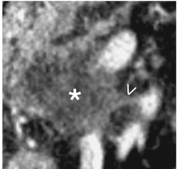 Key Features with EPNI on CT May More than Double Mortality Risk in Pancreatic Cancer