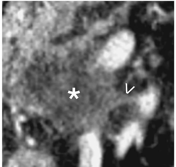 Key Features with EPNI on CT May More than Double Mortality Risk in Pancreatic Cancer