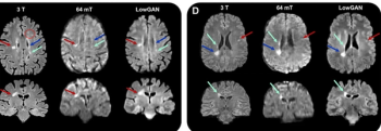 Can Deep Learning Enhance Low-Field MRI for Multiple Sclerosis Assessment?