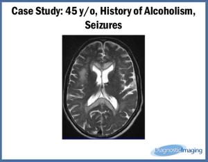 45 y/o, History of Alcoholism, Seizures