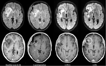 Is MRI Contrast Enhancement Necessary for Long-Term Monitoring of Diffuse Glioma?