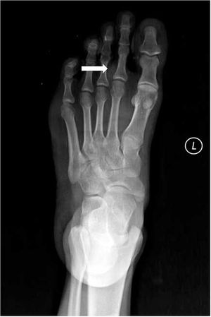 Arteriovenous Hemangioma of Foot