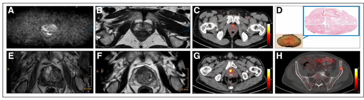 Study: PSMA PET/CT Changed Treatment Plans for Over a Third of Men with Prostate Cancer