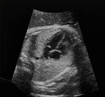 FDA Clears AI Software for Fetal Heart Ultrasound Assessment