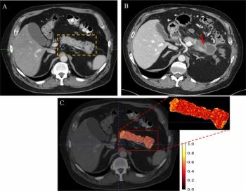 Can a Radiomic AI Model Facilitate Earlier CT Detection of Pancreatic Ductal Adenocarcinoma?