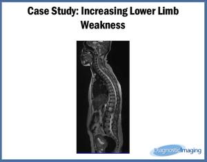 Increasing Lower Limb Weakness