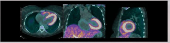 PET Agent Gets FDA Fast Track Designation for Cardiac AL and ATTR Amyloidosis