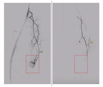 New Interventional Radiology Research Shows Merits of Genicular Artery Embolization for Knee OA