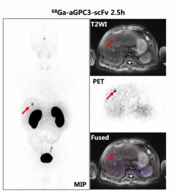 Could an Emerging PET Tracer be a Game Changer for Detecting Hepatocellular Carcinoma?