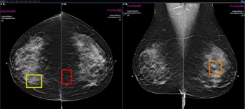 Mammography Study: Paying for Adjunctive AI Screening Led to 43 Percent Higher Rate of Breast Cancer Detection