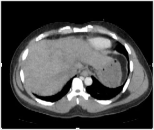 Image IQ Quiz: Middle-Aged Male with Abdominal Pain and Lower Extremity Edema
