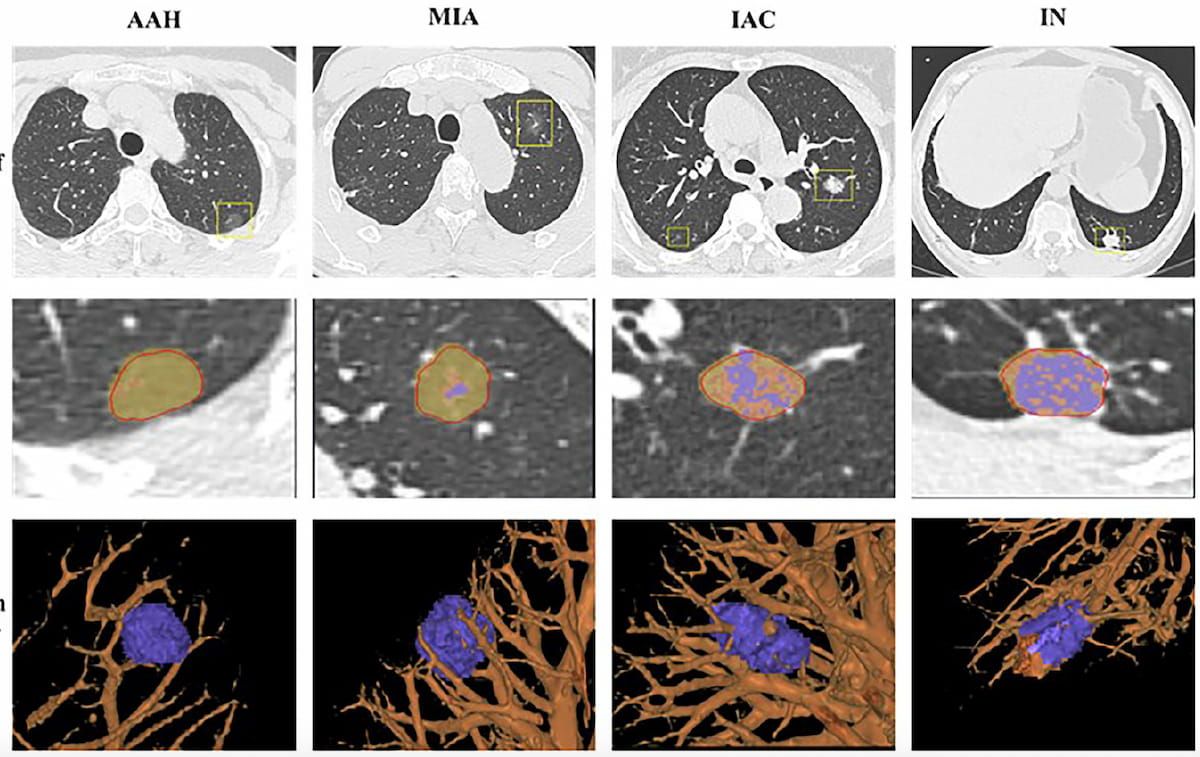 Can AI-Enhanced Radiomics Improve Differentiation of Pulmonary Nodules on Chest CT?