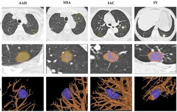 Can AI-Enhanced Radiomics Improve Differentiation of Pulmonary Nodules on Chest CT?