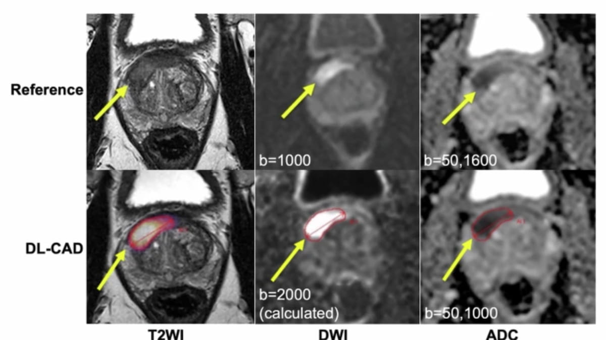 Can AI Have an Impact in Detecting and Classifying Prostate Lesions on bpMRI?