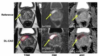 Can AI Have an Impact in Detecting and Classifying Prostate Lesions on bpMRI?