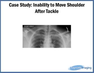 Inability to Move Shoulder After Tackle