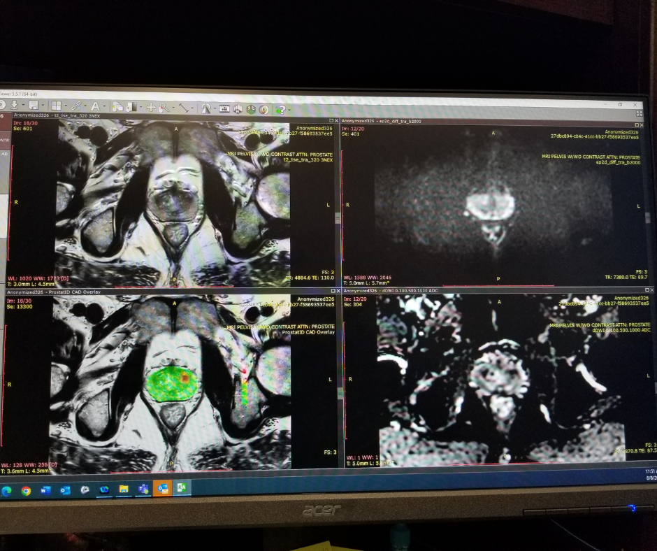 FDA Clears New AI Software for MRI Detection of Prostate Cancer