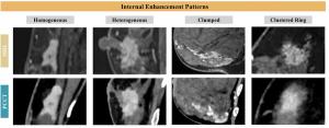Can Photon-Counting CT Have an Impact in Breast Cancer Staging?