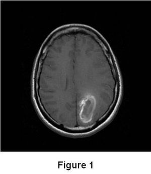 Dural Venous Thrombosis