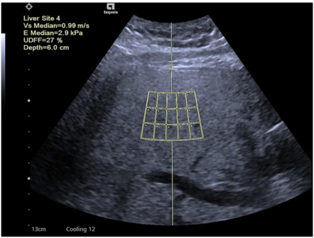 Can Ultrasound-Derived Fat Fraction Provide a Viable Alternative for Quantifying Hepatic Steatosis?